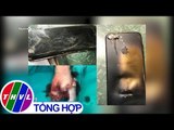 THVL | Bé trai 13 tuổi phải cắt cụt tay do điện thoại phát nổ khi đang sạc