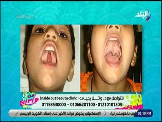 ست الستات - طرق علاج الحلق المشقوق - د. وائل يحيي