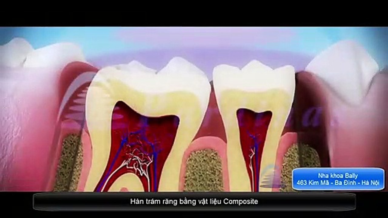 Kỹ thuật Hàn Trám răng bằng Composite bền chắc suốt 5 năm