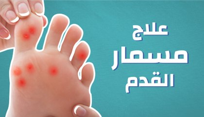 علاج مسمار القدم