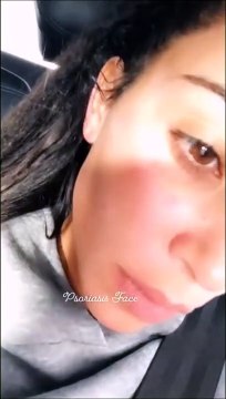 Kim Kardashian démaquillée nous montre son psoriasis