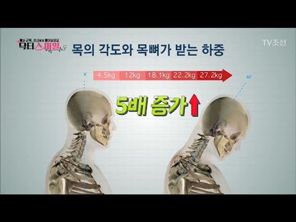 구부정한 자세가 안 좋은 이유? 당신의 목이 위험하다! [닥터 스마일] 4회 2017...