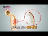 꼬부랑 할머니 병을 부르는 ‘척추관협착증’ 증상들 [닥터 스마일] 5회 20170801