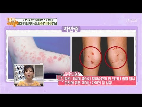 전신에 염증 발생! ‘잠복염증’의 심각한 증상들! [내 몸 사용설명서] 166회 20170818