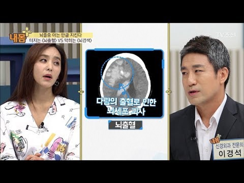 뇌출혈과 뇌경색의 차이 그리고 뇌졸중 [내 몸 플러스] 77회 20171022