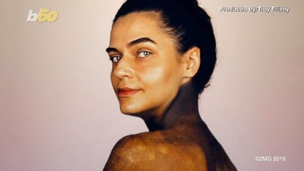 New Exhibition Shows People with Rare Condition Being Comfortable in Their Skin