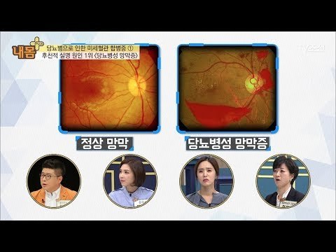 당뇨병으로 인한 실명 ‘당뇨병성 망막증’ [내 몸 플러스] 79회 20171112