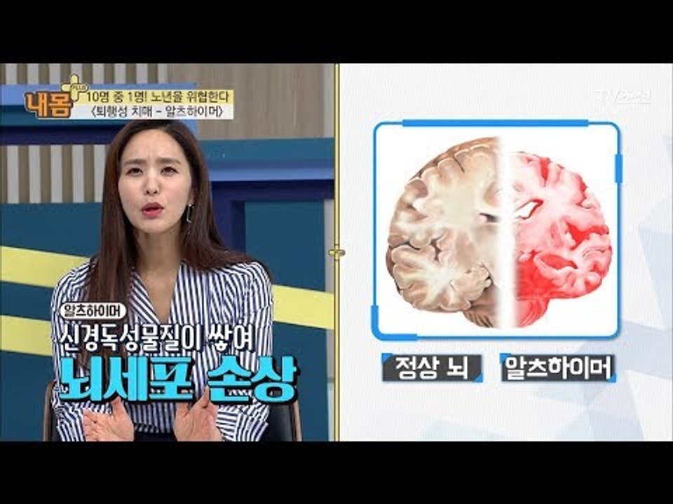 치매도 다양하다?! ‘알츠하이머’를 조심하라! [내 몸 플러스] 78회 20171105