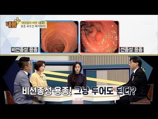 대장암의 씨앗 ‘용종’ 무조선 제거하라! [내 몸 플러스] 81회 20171126