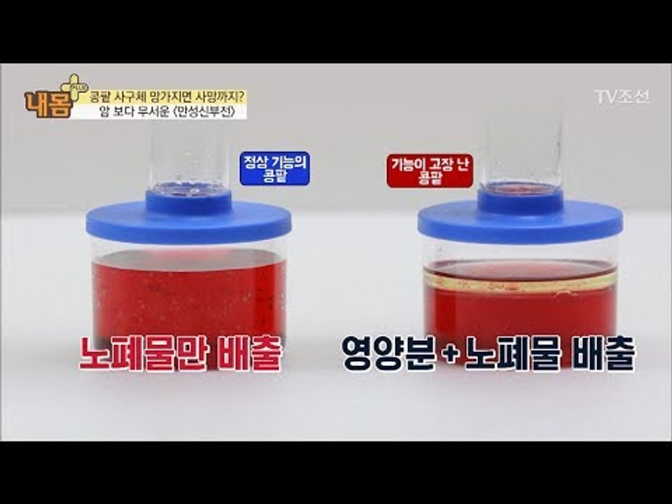 콩팥이 망가지면 사망까지?! [내 몸 플러스] 82회 20171203