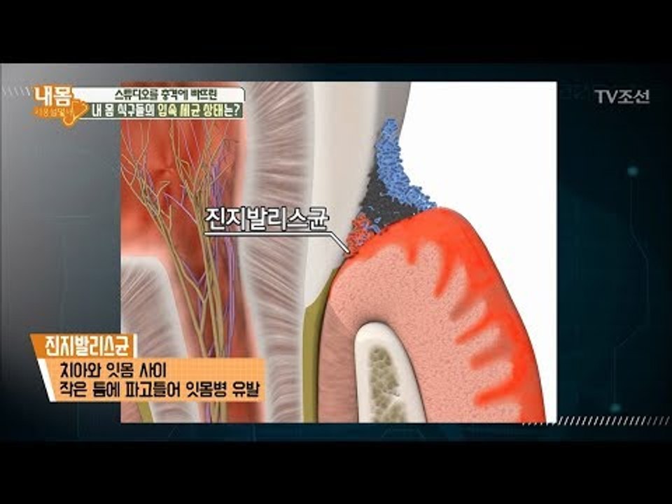 가장 위험한 입속 두 가지 입속 세균! [내 몸 사용설명서] 187회 20180112