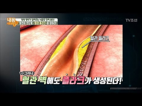 뇌졸중의 강력한 원인 ‘혈관 플라크’ [내 몸 사용설명서] 193회 20180223