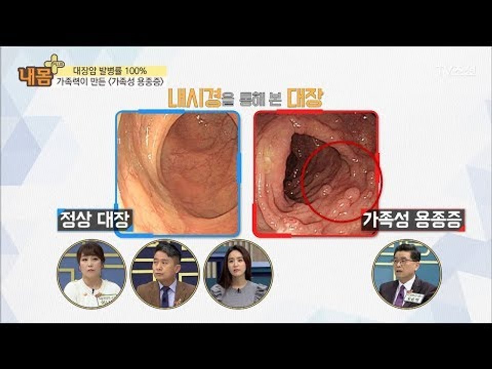 대장암 발병률 100% ‘가족성 용종증’ [내 몸 플러스] 89회 20180204