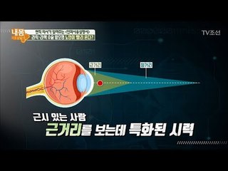 라식, 라섹 수술을 받으면 노안이 빨리 온다? [내 몸 사용설명서] 192회 20180216