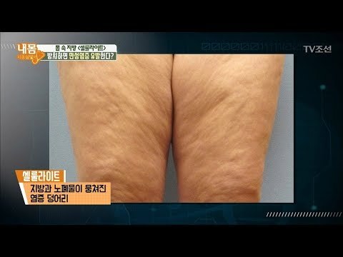 너의 지방 셀룰라이트가 염증 그 자체였다! [내 몸 사용설명서] 196회 20180316