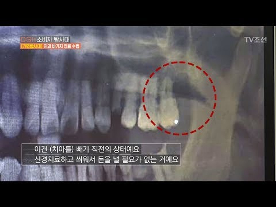 ‘임플란트 시술시’ 신경치료를 꼭 받아야 할까? [CSI 소비자 탐사대 25회] 20...