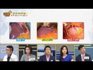 정상 간 vs 굳은 간, 굳으면 재생 불가! [내 몸 플러스] 106회 20180624
