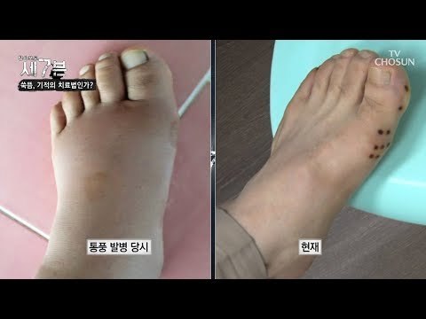 통풍 치료에도 특효! 뜸이 90프로 이상의 효능? [탐사보도 세븐 49회] 20180822