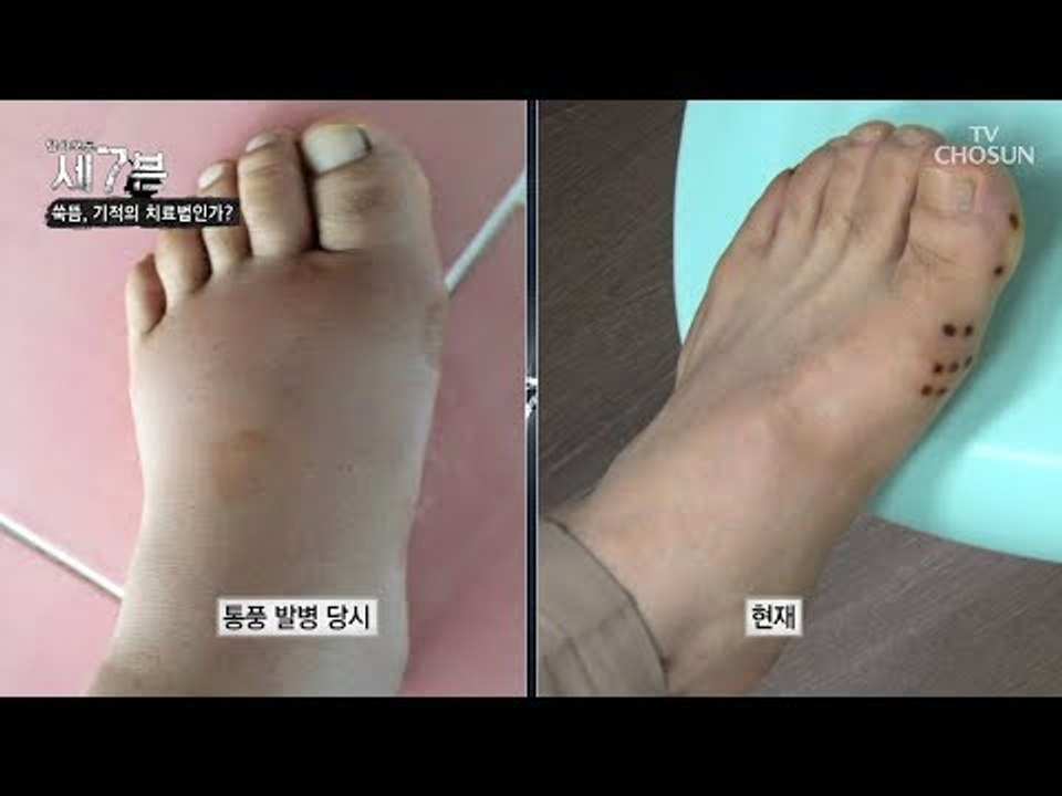 통풍 치료에도 특효! 뜸이 90프로 이상의 효능? [탐사보도 세븐 49회] 20180822