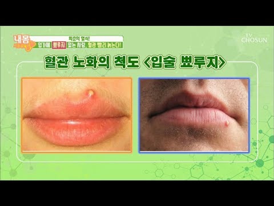 혈관 늙음의 지름길?! 입가 주변에 생기는 빨강색은 무엇?! [내 몸 사용설명서] 2...