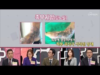 ‘당뇨’로 다리 절단까지? 세계 1위 발병률 증가! [내 몸 플러스] 118회 20181028