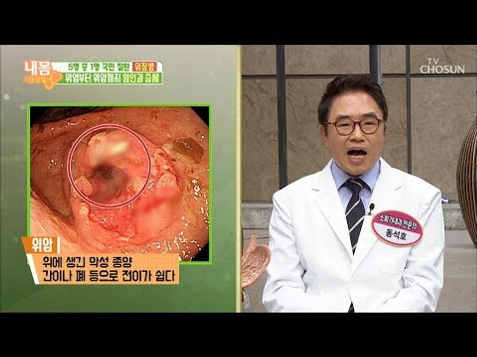 국민 질환 위장병! 40대 이상이면 위암 검사 필수! [내 몸 사용설명서] 238회...