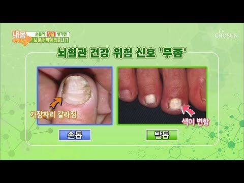 손톱 무좀? 뇌혈관 위험 신호다?! [내 몸 사용설명서] 240회 20190222