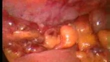 Lap appendectomy with stapler