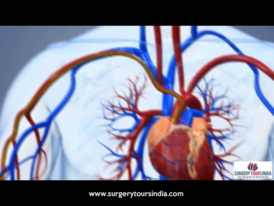 Coronary Angioplasty in India | Surgery Tours India
