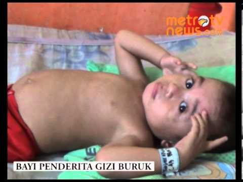 Malang Balita Kurang Gizi Ini