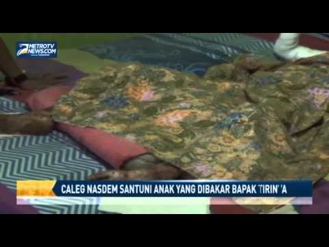 Caleg Nasdem Santuni Anak yang Dibakar Bapak Tirinya