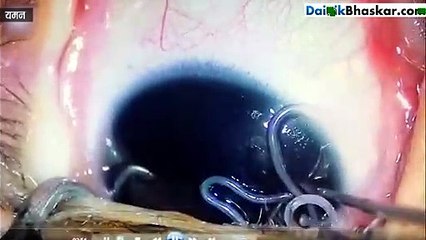 डॉक्टर बच्चे की आंख देखते ही रह गए शॉक्ड