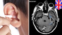 Man develops brain infection after cleaning ear with cotton swab