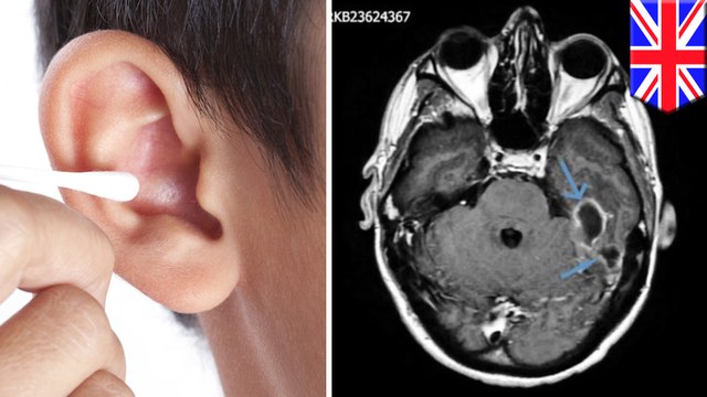 Man develops brain infection after cleaning ear with cotton swab