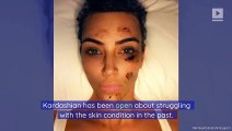 Kim Kardashian Reveals Her Psoriasis Outbreak