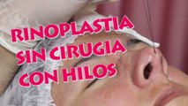 RINOPLASTIA O RINOMODELACION CON HILOS: un cambio en tu nariz sin entrar a quirofano.