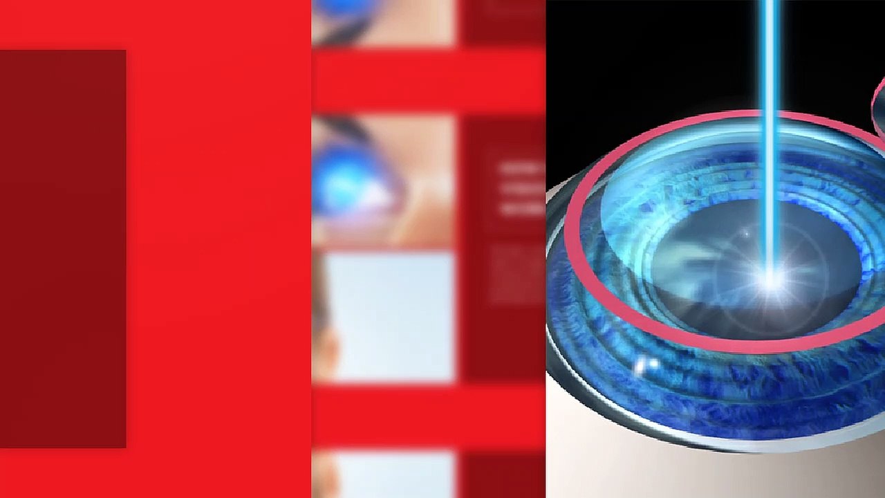 Lasik Eye Surgery in Oshiwara Mumbai - Arohi Eye Hospital