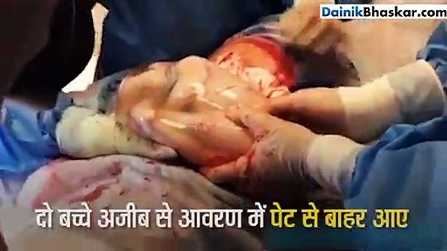 महिला ने एक साथ दिया 3 जुड़वां बच्चों को जन्म, पर तीसरे के आने पर घटी एक घटना
