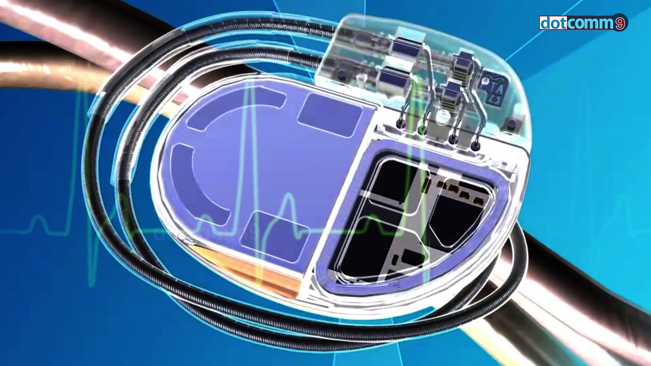 cardiac pacemaker వలన గుండెకు ఉన్న ఉపయోగం ఏమిటి తీసుకోవలసిన జాగ్రతలు ఏమిటి