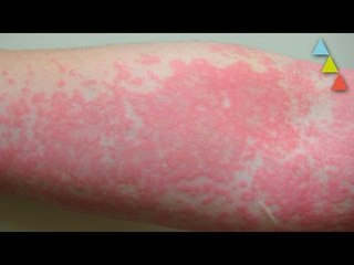 Las 10 alergias más raras del mundo