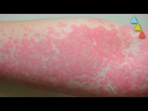 Las 10 alergias más raras del mundo