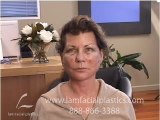 DALLAS PLASTIC SURGERY:  FACE LIFT FAT GRAFTING RECOVERY