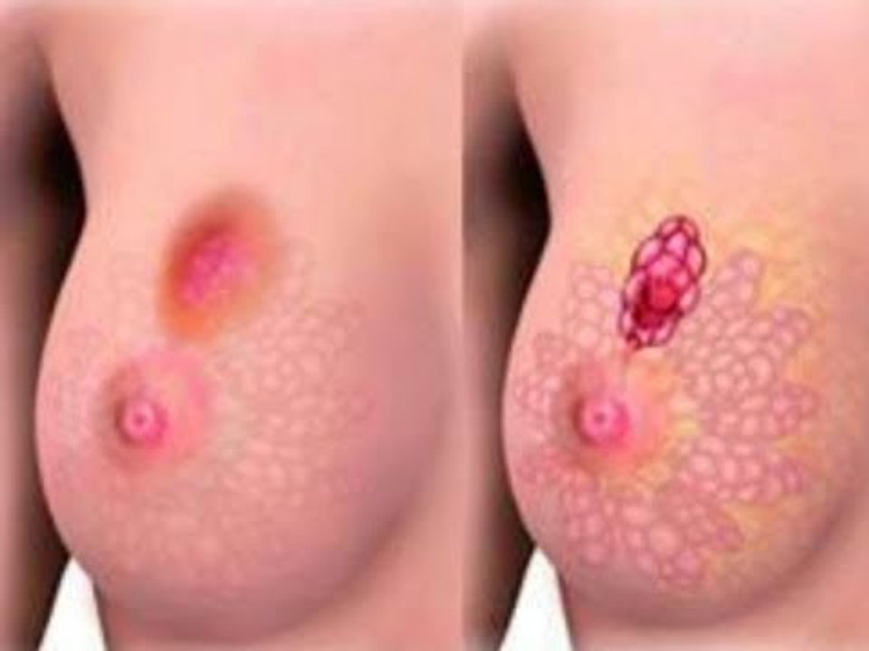 Mitos comunes sobre el cáncer de mama | Noticias con Francisco Zea