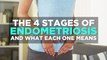 The 4 Stages of Endometriosis—and What Each One Means