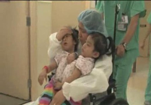 Siameses separadas con éxito