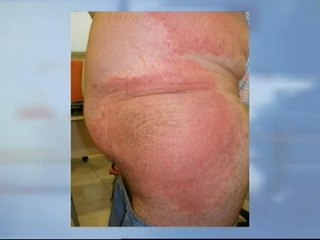 Un sofá fabricado en China causa fuertes alergias a su comprador