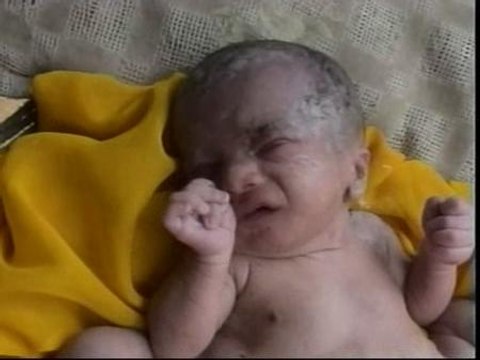 Nacen en la India unos gemelos que comparten tronco