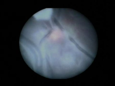 Médicos del Marañón separan con éxito en el vientre materno a dos gemelos con un problema en el flujo sanguíneo