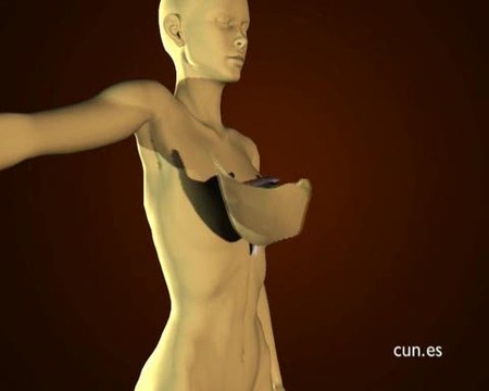 Primera reconstrucción mamaria con tejido del muslo de la paciente