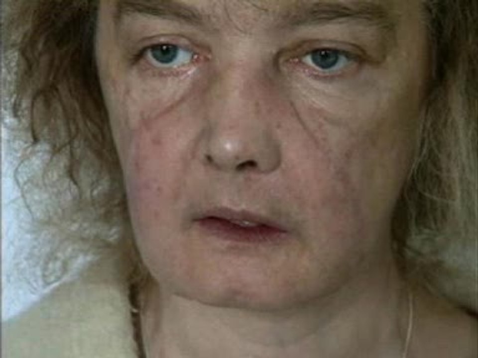 Evolución del primer transplante de cara